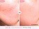 リジェネラティブセル メディカルサロン(Regenerative Cell Medical Salon)の写真/毛穴・くすみが気になる方へ♪透明感あふれるツヤ肌へ