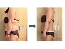 ルルラ(Rulula)/痩身ダイエット施術前後2