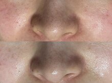 リボーン(REBORN)/毛穴の黒ずみ