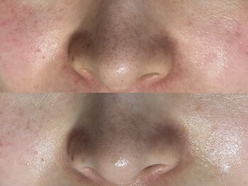 リボーン(REBORN)/毛穴の黒ずみ