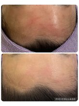 ルピナージュ(Lupinage)/【肌質改善】-赤み/痒み