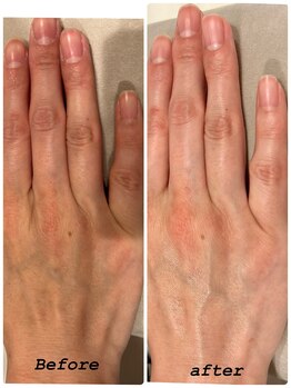 はだなの/ハンドケア　Before After