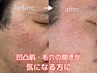 メンズ　【幹細胞＋パック付き】　　凹凸肌改善　プロセルセラピーズ