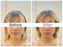 ウニカ(Unica)/1回目Before After