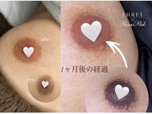 ローマピンク/三宮/角質ケア/国家資格者/韓国美容