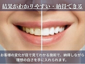ホワイトニングサロン ホワイト 天童店(WHITE)/見てわかる効果を実感♪