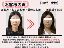 サロンスマイル/30代美容鍼ビフォーアフター
