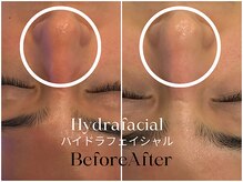 トウキョウビューティーラボ(TOKYO BEAUTY LABO.)/ハイドラBefore&After