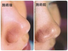 毛穴レスなお肌に