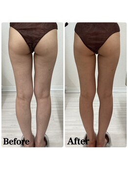 ルピア(L'pur)/下半身痩身★