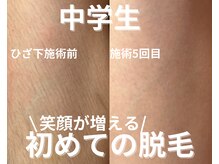 バーム(BAAM)/学生脱毛