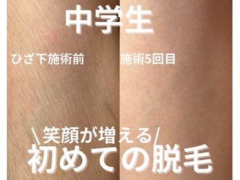 バーム(BAAM)/学生脱毛