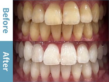 アース 岡崎店(EARTH)/【ビフォーアフター】美白