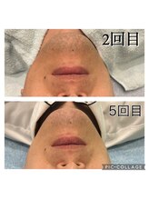 レイモード(Ray mode)/髭脱毛(爆抜け)