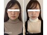 【新メニュー記念価格!!】３D小顔施術＋備長炭配合石膏マスク 9500円