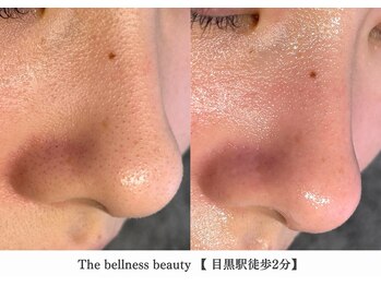 ザ ベルネス(The bellness)/【毛穴洗浄】東京/目黒駅