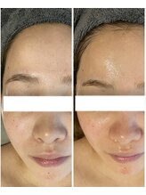 エヌ(enu)/毛穴洗浄/脱毛/フェイシャル