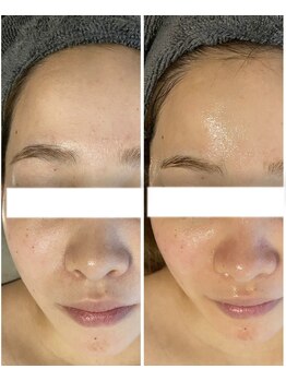 エヌ(enu)/毛穴洗浄/脱毛/フェイシャル