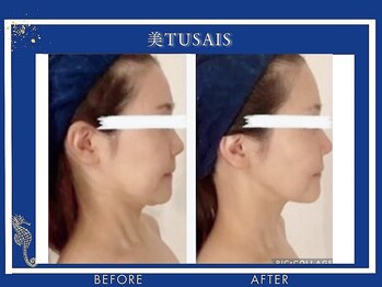 ビテュセ(美Tu sais)/小顔症例【小顔／松山／愛媛】