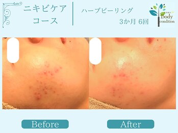 ボディコンディション/ハーブピーリング/毛穴洗浄/小顔