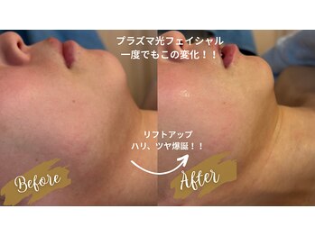 サロン リノ(salon rino)/光フェイシャルリフトアップ