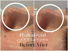 トウキョウビューティーラボ(TOKYO BEAUTY LABO.)/ハイドラBefore&After