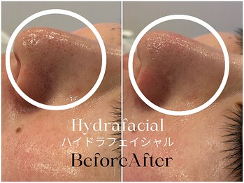 トウキョウビューティーラボ(TOKYO BEAUTY LABO.)/ハイドラBefore&After