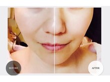 GRACETHOUSAND(グレイスサウザンド)/【肌質改善】ハーブピーリング