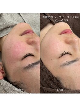 タグ 高知駅前店(Tug)/【頬の赤み・毛穴】