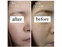 ポエマ(POEMA)/before/after