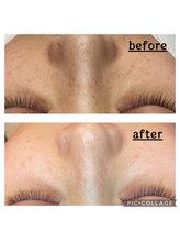 フォビィサロン(FOBE...salon)/シミケア