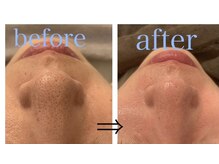 リジュベ(Rejuve)/毛穴洗浄/ブライダルエステ/美肌