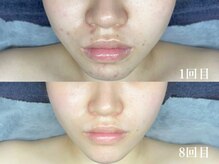 和歌山ララピール&韓国肌管理専門店/ララピール×LDM