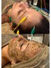【頑固な毛穴でお悩みの方】電気美容鍼×REViハーブピーリング120min