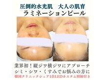 キレナル(KIRENAL)