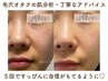 【初回限定C】ザラツキ/詰り &nbsp;肌診断×深層ピーリング× 〈顔全体〉毛穴洗浄