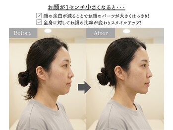 アジール 新潟市(agir)/1cmで横顔が変わる