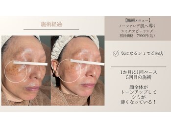 ピーロ(PiiiLO)/濃くなるシミには、早めのケアを