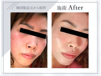 サロンドゥレーヴシエル(Salon de reve Ciel...)/【微細針“肌改革プログラム”】