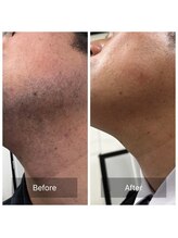 ロココ(LOCOCO)/大人気！ヒゲ脱毛！