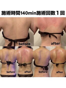 パレス(PALACE)/痩身【背中】フルコース140min