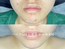 和歌山ララピール&韓国肌管理専門店/ハーブピーリング×ララピール