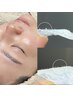 エステ人気No.1【フェイシャルワックス】産毛やくすみ・黒ずみ毛穴の改善に◎