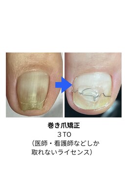 ナチュエイド/巻き爪矯正　３TO