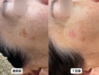 エングラッシー(en glassy)/BEFORE　AFTER　最新シミ回収