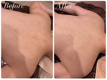 エール 恵比寿店(AILES)/背中上部ハーブピーリング