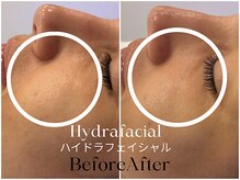 トウキョウビューティーラボ(TOKYO BEAUTY LABO.)/ハイドラBefore&After
