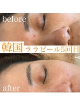 グレイティア(gratia)/鼻の黒ずみにもララピール！