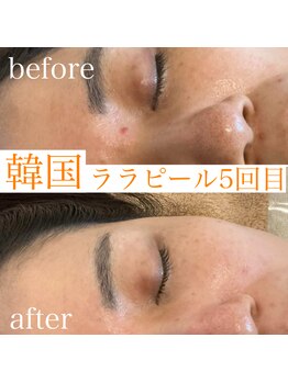 グレイティア(gratia)/鼻の黒ずみにもララピール!