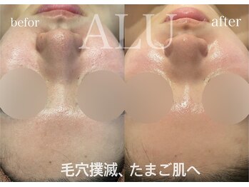アルフォービューティー 恵比寿店(ALU for beauty)/毛穴改善症例